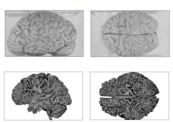 Creierul unei persoane sănătoase (sus) și creierul unui alcoolic cu consecințe ireversibile (jos)