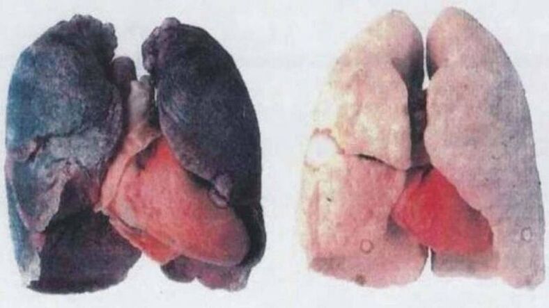 Mulți alcoolici cronici mor din cauza leziunilor pulmonare (stânga)